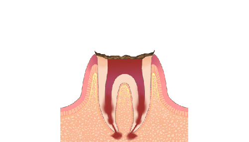 慢性根尖性歯周病