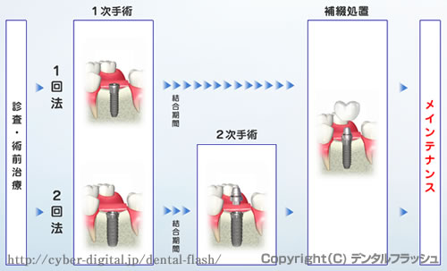 インプラントの流れ